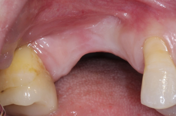 Preoperative photo, buccal