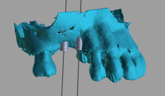 3D rendered dental implant placement design