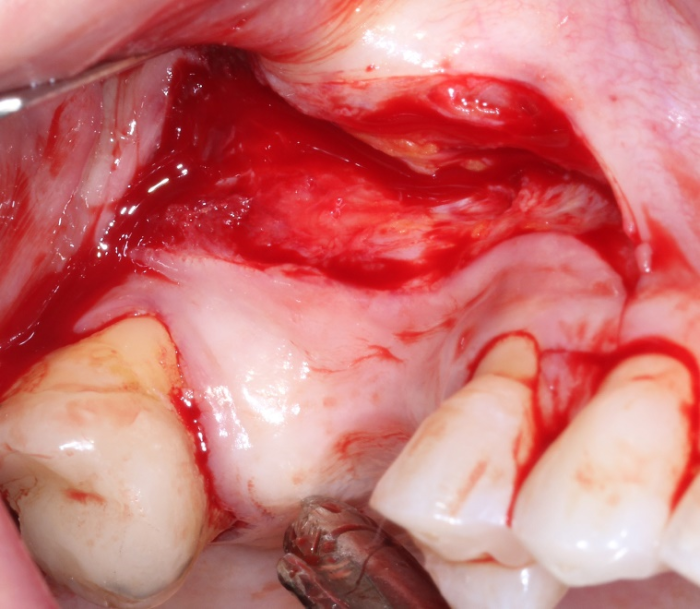 Initial mucosal incision. A secondary incision is made in the periosteum and the flap is then reflected.