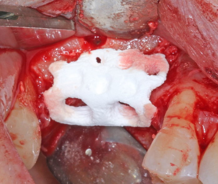 The OsseoConduct 3D-printed graft is tried in place while Sinus Graft is prepared for the sinus augmentation portion of the surgery.