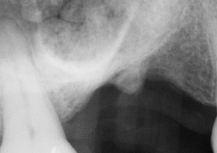 Sinus Graft is injected, and the sinus membrane is lifted hydraulically.