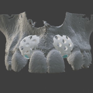3D-Printed Tissue Regeneration