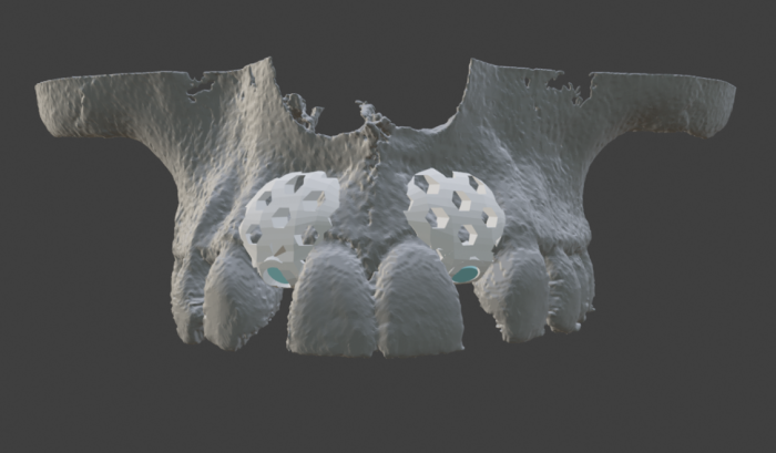 3D-printed dental bone graft design