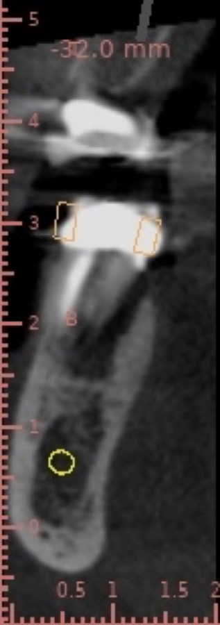 Preop slice of implant planning CBCT. You can see the crack and extent of the lesion on the M root.