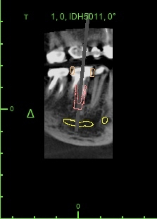 Another view of the planned dental implant position.