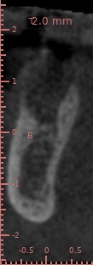 Low res CBCT slice is from the day of early implant placement, just 3 weeks after extraction and grafting.