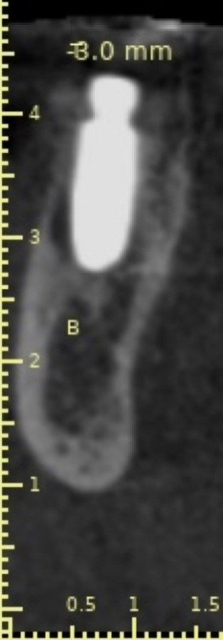 CBCT of dental implant post op; implant is placed without incisions, flaps, and exposure of the bone and sutures.