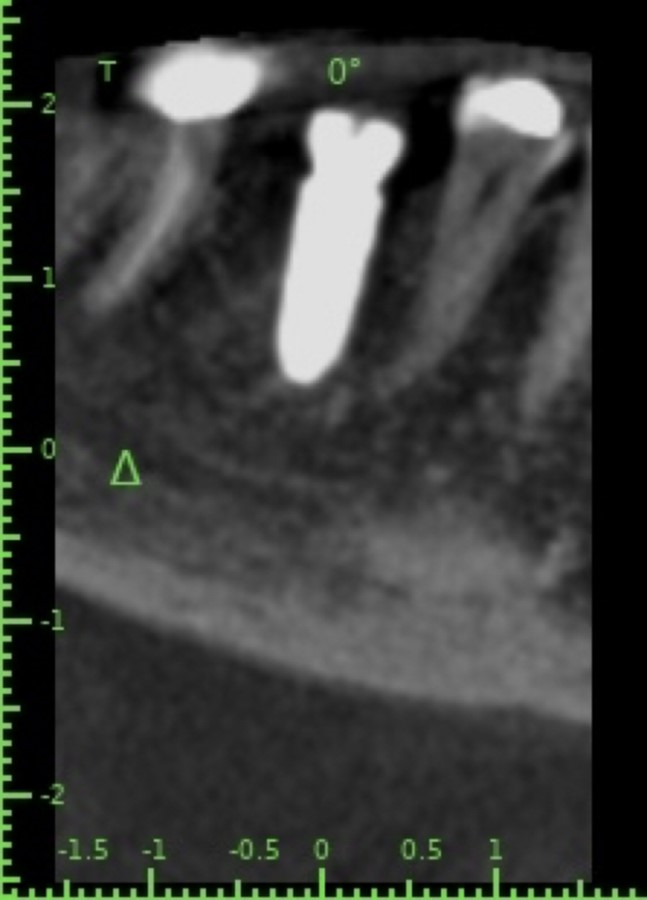 Implant post op CBCT. Dr. Bickel was able to achieve 35 NCm of torque, even with most of the implant in immature bone.