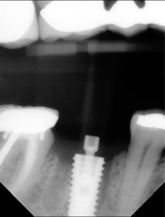 This is the scan body radiograph taken just 2 months post extraction and grafting, and 5 weeks post implant placement.