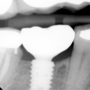Early Implants: Pushing the Envelope on Bone Regeneration