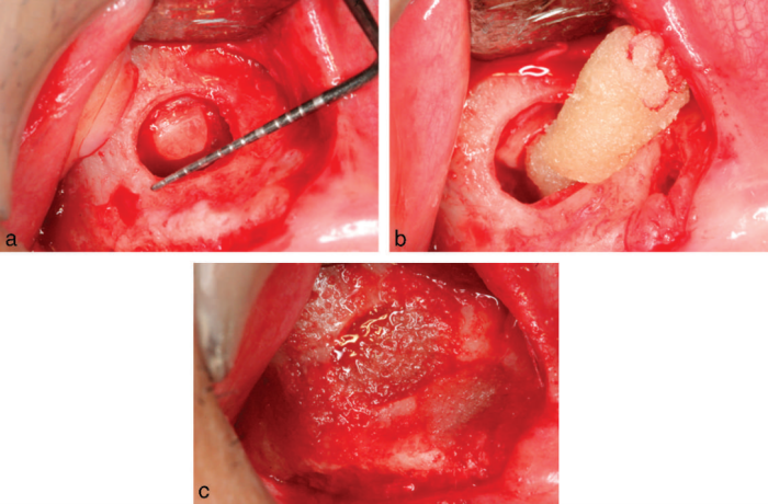 An oval osteotomy was made with piezoelectric surgery for patient
