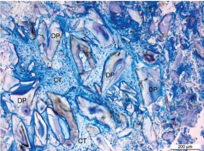 6-month specimen revealed only irregular-shaped residual alloplastic particles embedded in loose connective tissue.