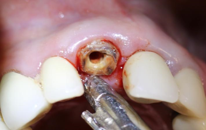the crown is removed and sulcular incisions are made to separate the gingival attachment