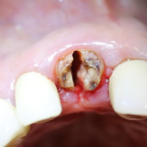 Atraumatic Extraction Method