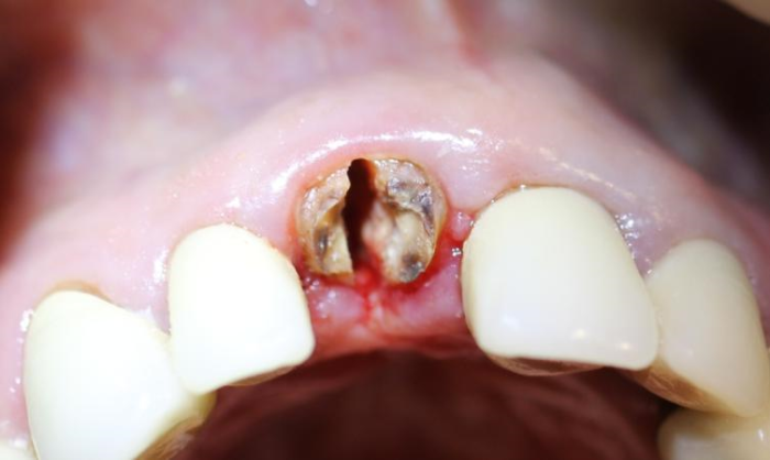 The root is cut in the buccal-lingual direction with a small amount of root structure on the buccal