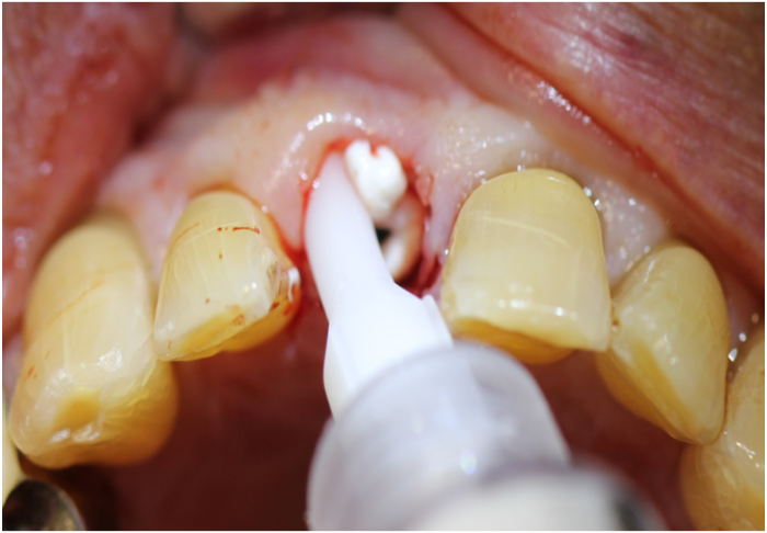 grafting is required to maintain the bone lining the extraction socket