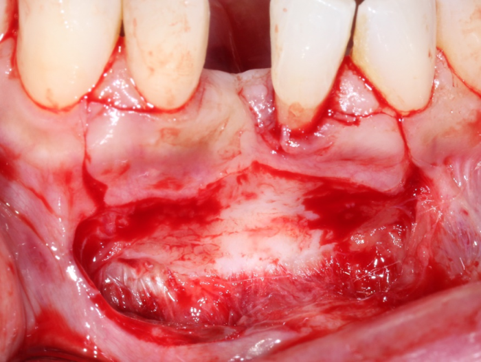 initial incision is a split thickness into the mucosa with vertical releasing incisions up into the attached gingiva