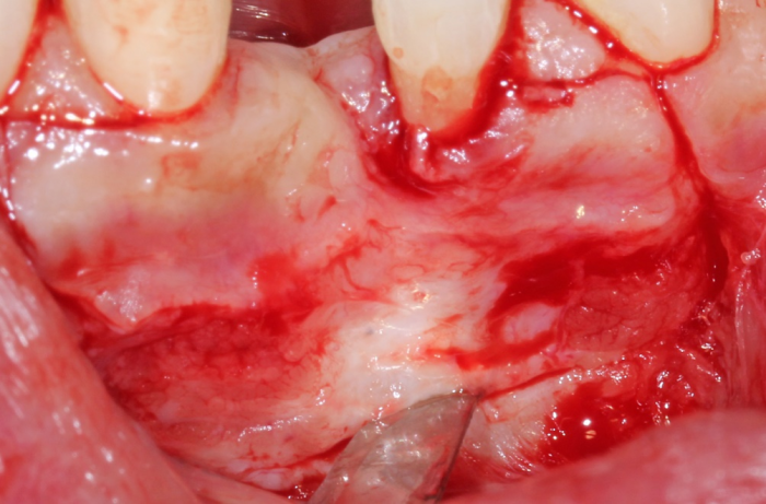 Second incision is made approximately 4mm apical to the mucosal incision through the periosteum