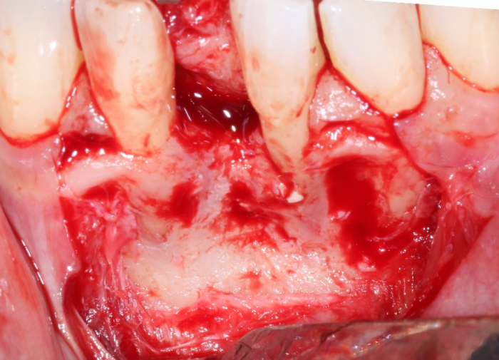 The tissue coronal to the periosteal incision is reflected and positioned lingual to the incisors