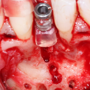 Successful 3D Ridge Augmentation with Implant Placement