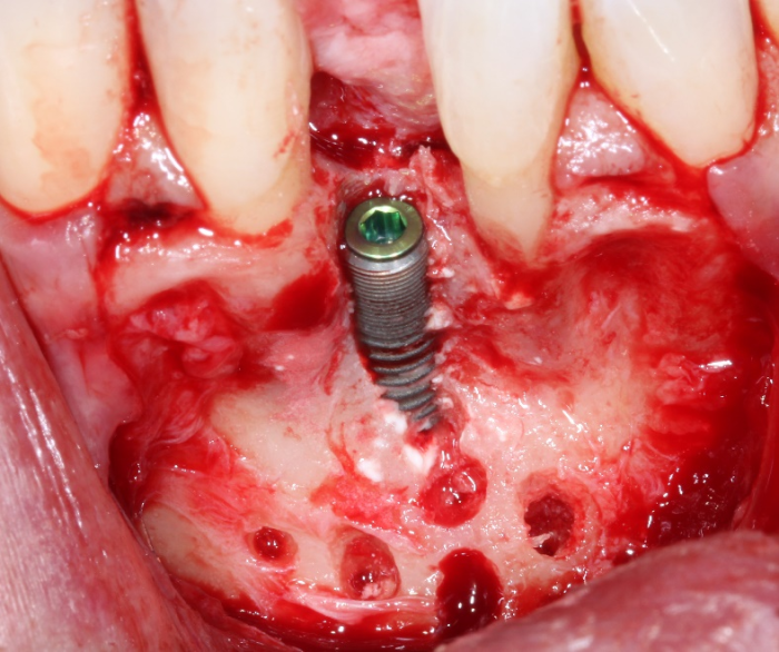 Side cutting burs are used to remove a portion of the lingual wall to prevent the implant from being displaced to the buccal.
