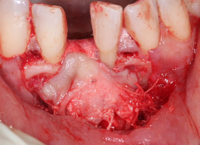 The periosteum that is joined to the attached gingiva at the mucogingival junction is sutured to the apical periosteal flap