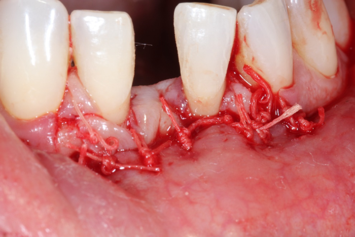 The mucosa is closed and also sealed with Oral Bond, creating a hermetically sealed site
