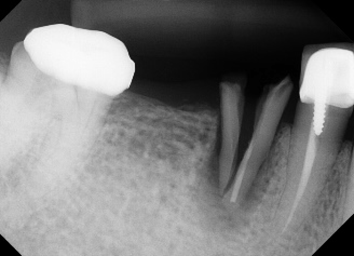 root fracture with 100% loss of buccal wall and 50% loss of lingual wall