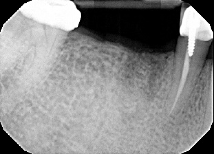 10 months post grating with Socket Graft Plus