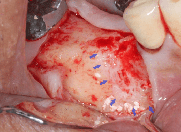all surface βTCP granules are resorbed except at apex of previous lesion