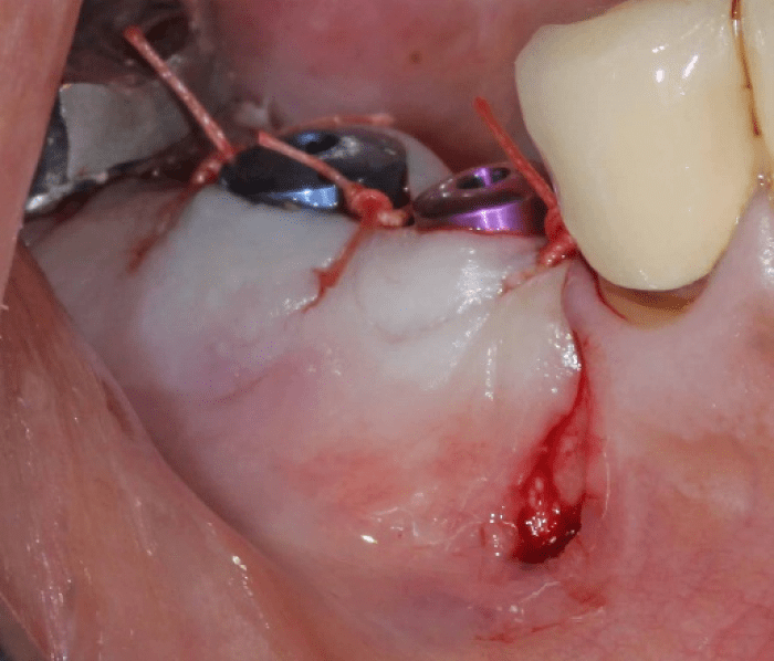 primary closure is required on buccal vertical incisions
