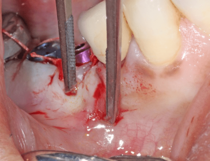 vertical releasing incision is closed with tissue pick-ups and Oral Bond