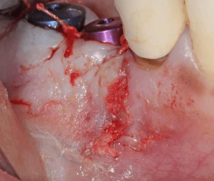 Oral Bond after closure of the buccal flap