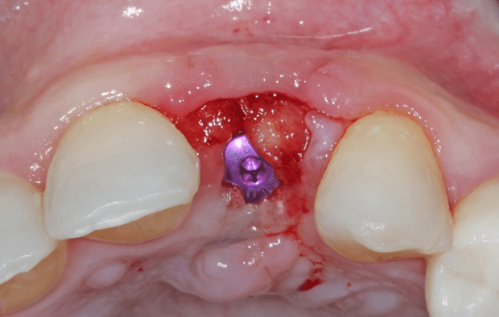 implant is placed 4 weeks after extraction