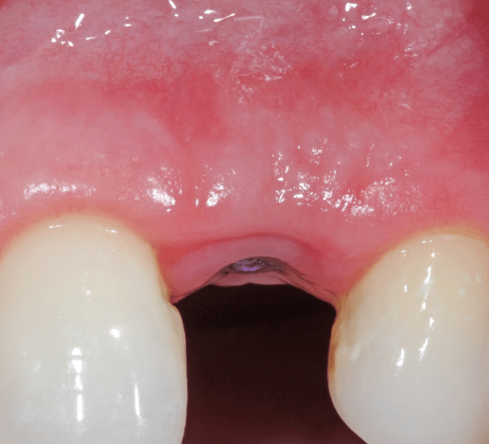 gingival margin maintained with no recession
