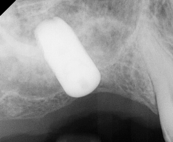day of graft and implant placement
