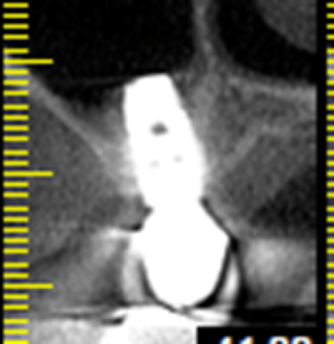 post op CT scan, bone covers the implant