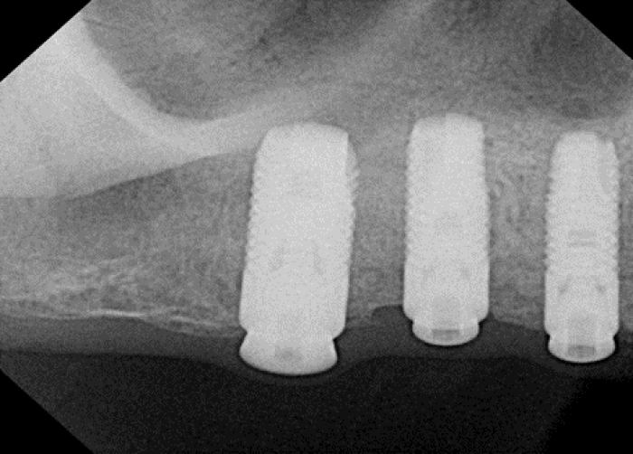healing abutment appointment