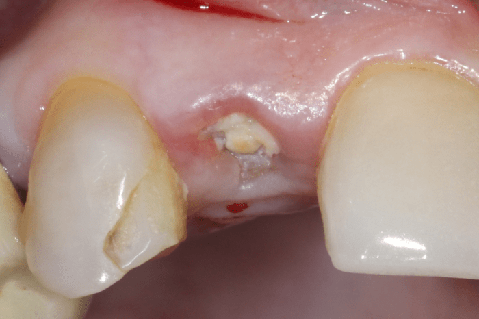 gingival margin is intact