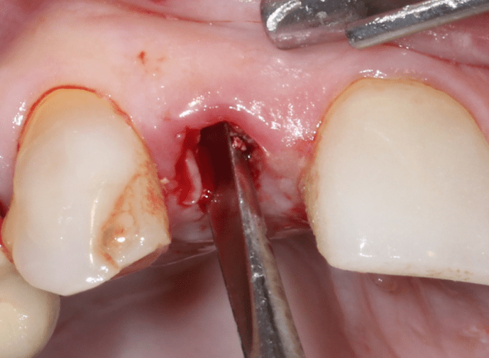tooth is sectioned buccal and lingual for atraumatic extraction