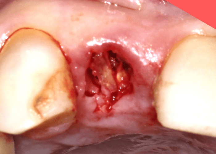 periodontal ligament has been separated from the root and bone after sectioning
