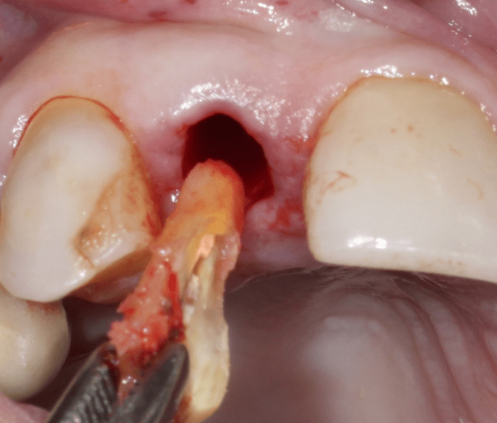 remainder of root is easily removed with extraction forceps