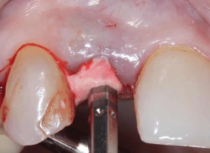 BioDensification fills voids between implant and socket wall