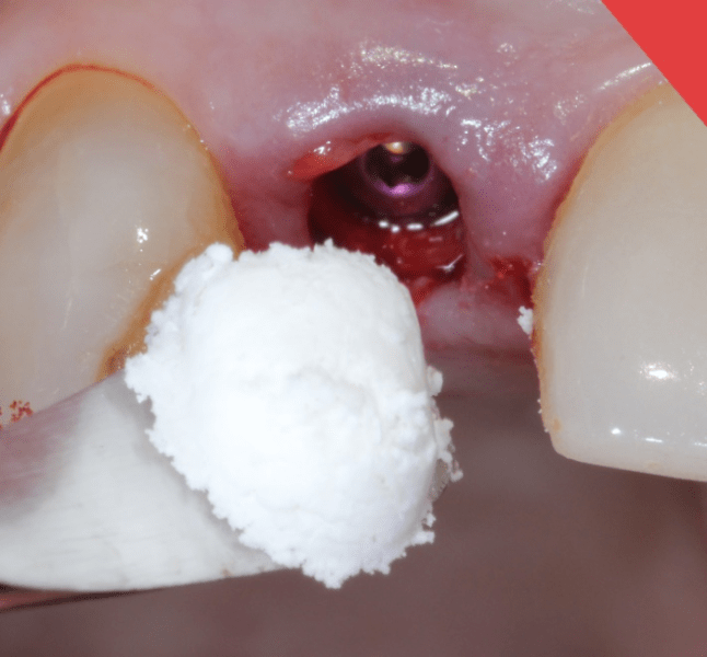Immediate Graft is gently packed into the defects