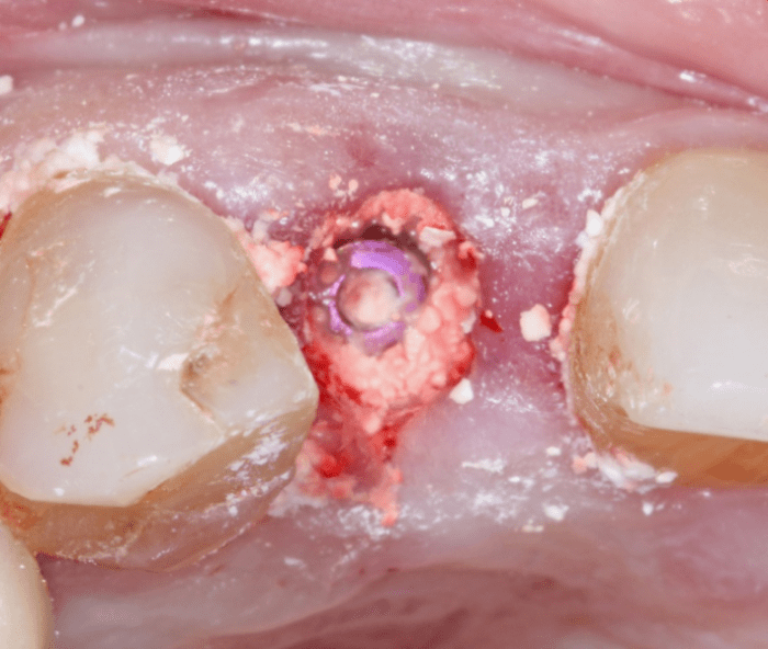 defects filled between bone and implant and cover screw is exposed