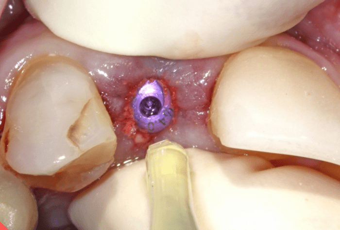 gingiva is compressed and Oral Bond is applied