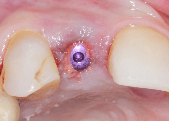 defects in the coronal portion of implant filled with Immediate Graft