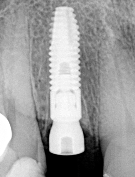 post-op radiograph shows all defects filled