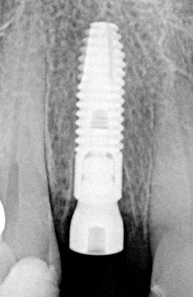 2-week post op showing graft material is retained and mineralization