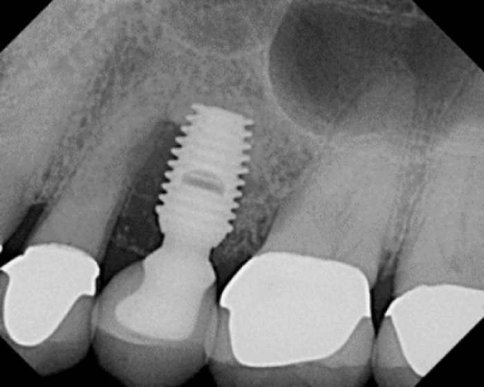 Rehabilitating Sites Grafted With Cadaver Bone Grafts